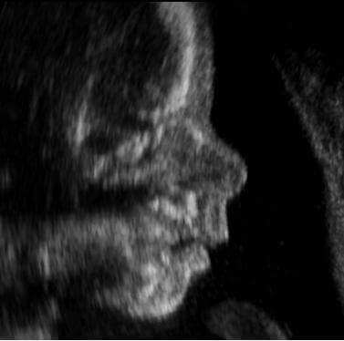 Fetal ultrasound